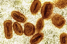 maringa-confirma-primeiro-caso-de-mpox;-veja-sintomas