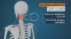 hematoma-epidural-cervical-espontaneo:-entenda-condicao-que-fez-jovem-perder-movimentos-do-corpo-apos-dor-na-nuca